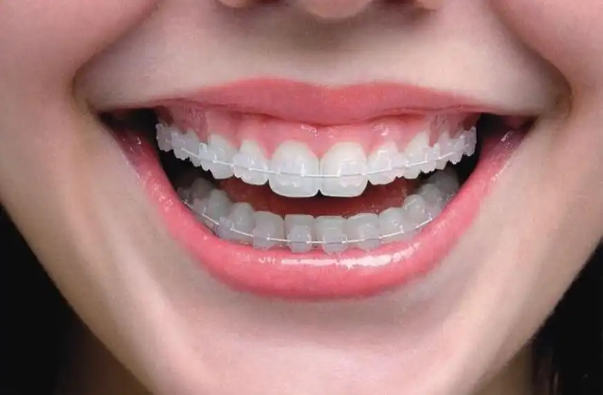 هزینه ارتودنسی سرامیکی